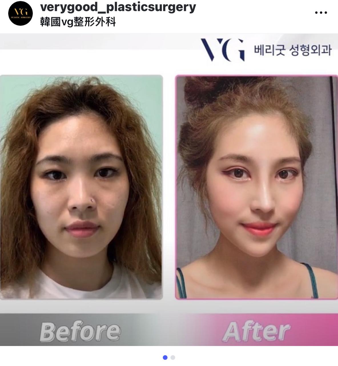 Before and after result by Dr. Im Young Min