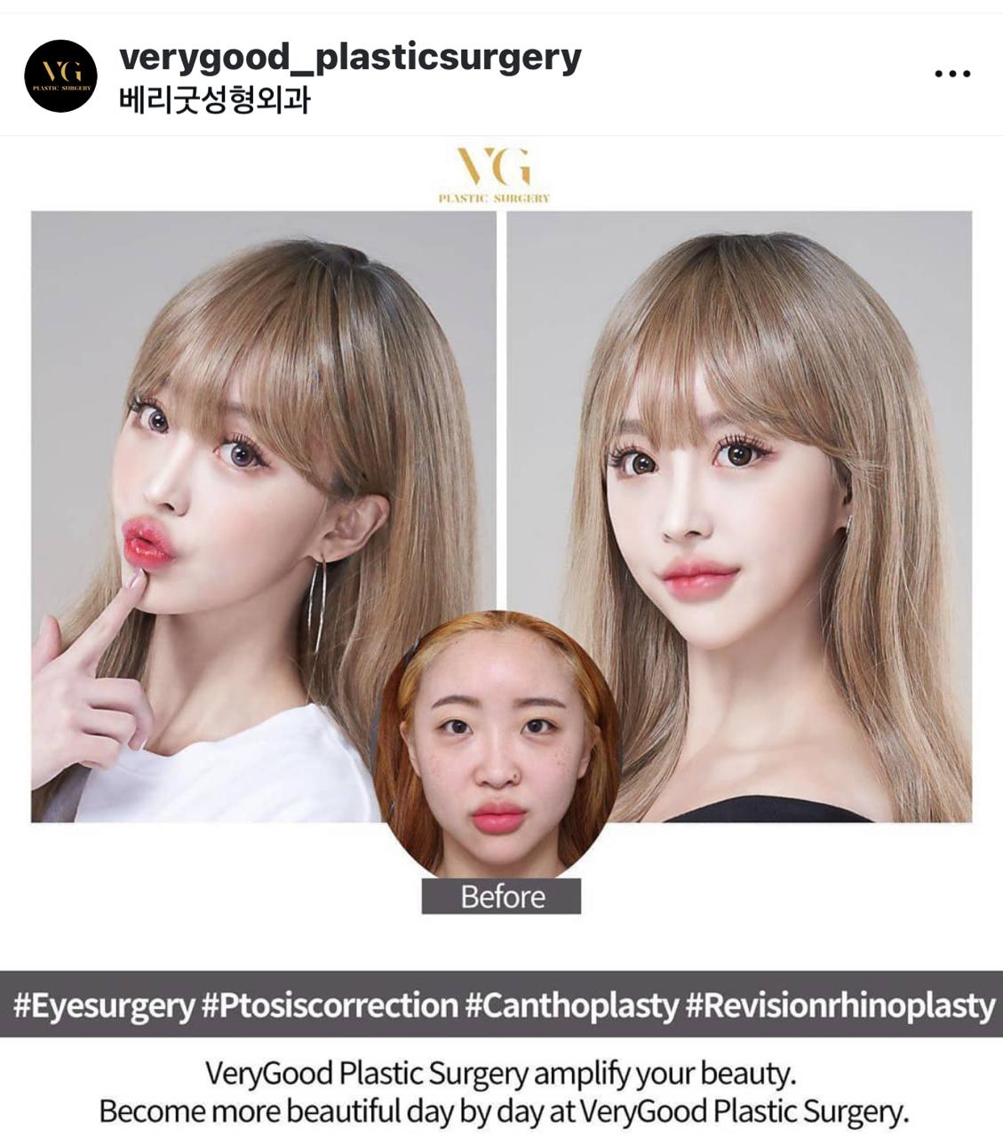 Before and after result by Dr. Im Young Min