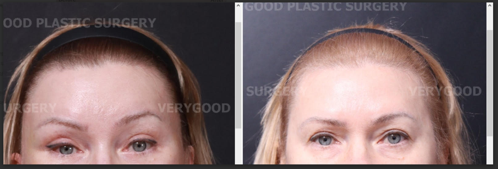 Before and after result by Dr. Im Young Min
