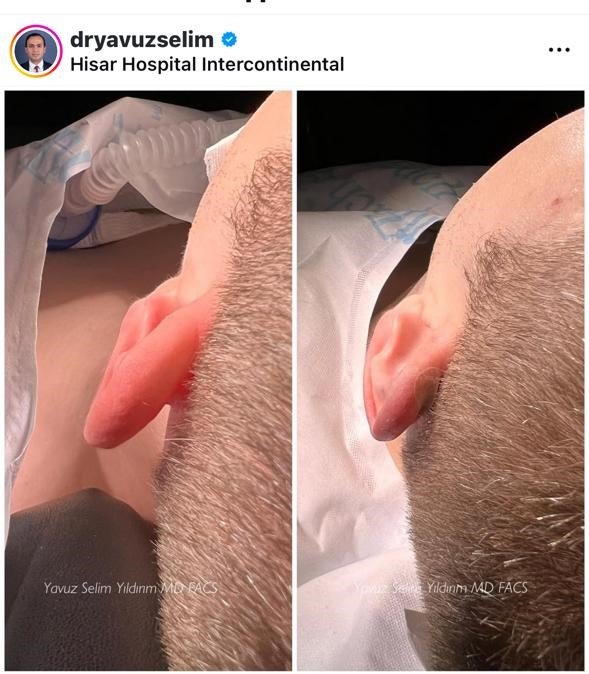 Before and after result by Dr. Yavuz Selim Yıldırım