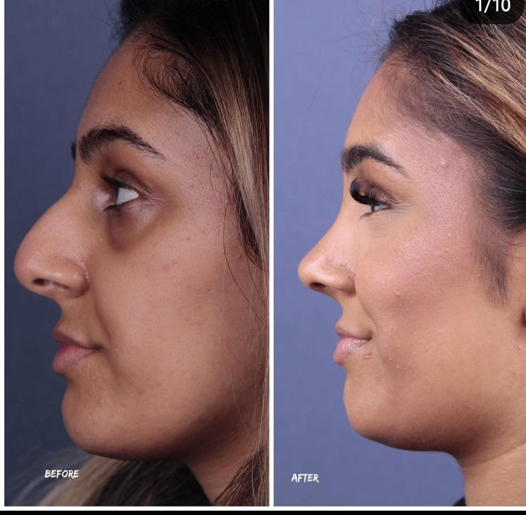 Before and after result by Dr. Yavuz Selim Yıldırım