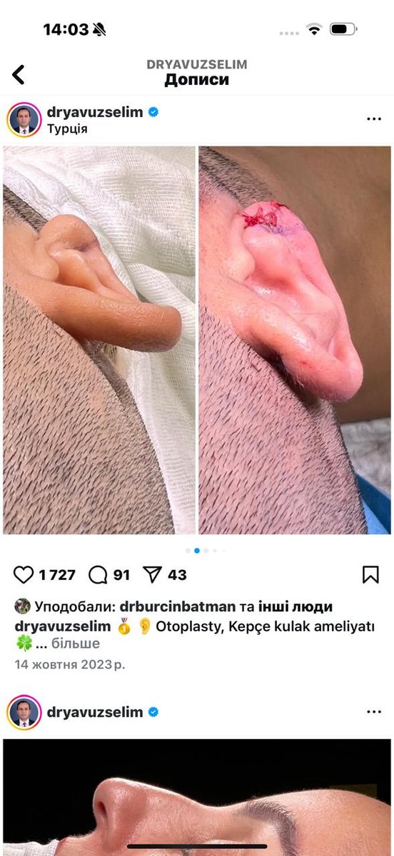Before and after result by Dr. Yavuz Selim Yıldırım