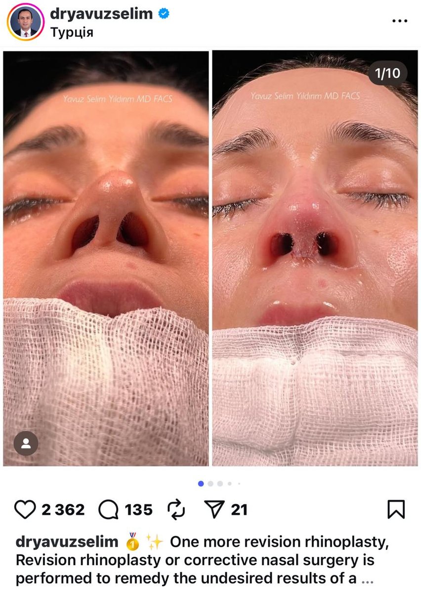 Before and after result by Dr. Yavuz Selim Yıldırım