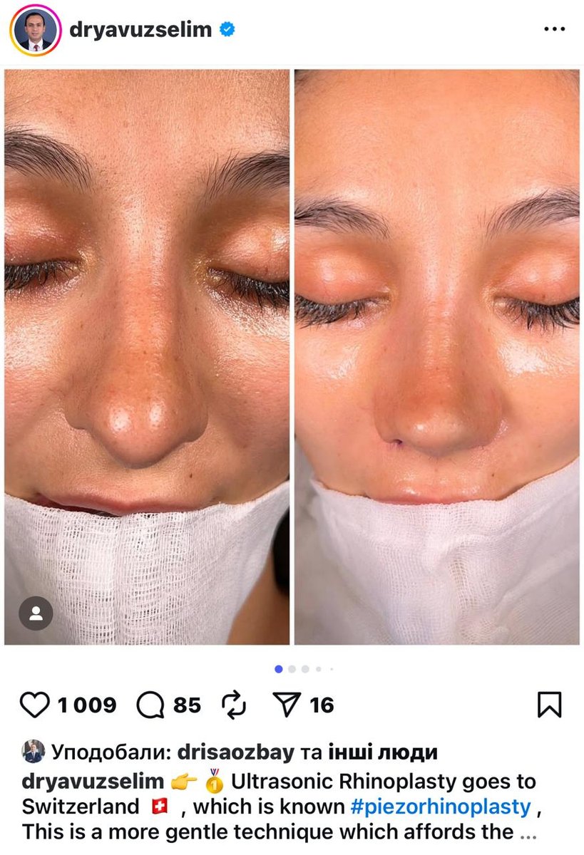 Before and after result by Dr. Yavuz Selim Yıldırım