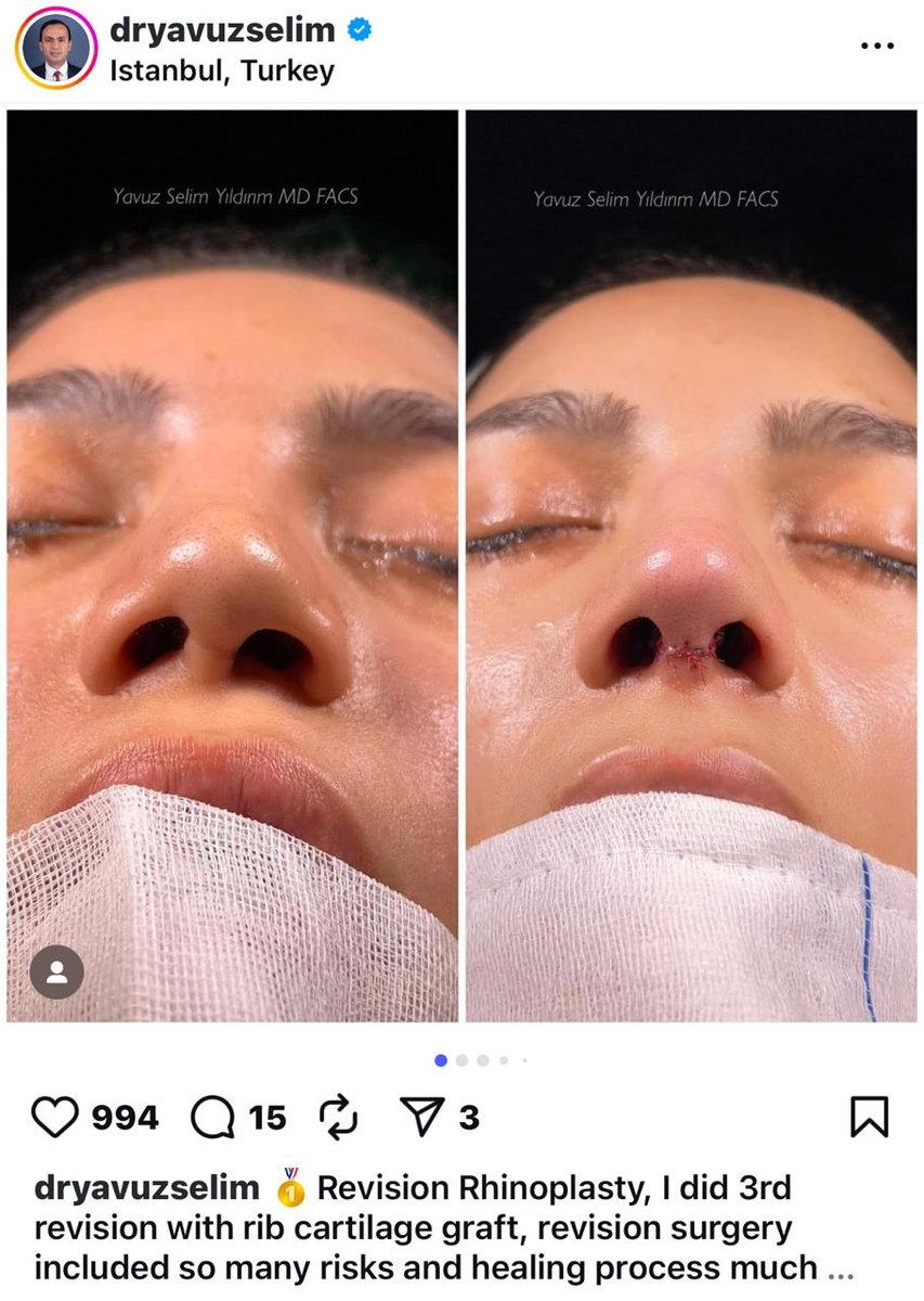 Before and after result by Dr. Yavuz Selim Yıldırım