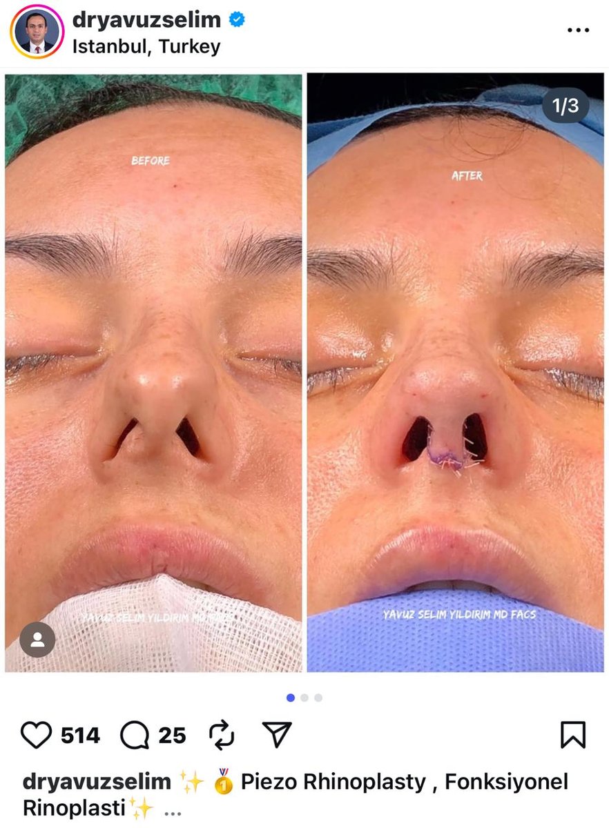 Before and after result by Dr. Yavuz Selim Yıldırım
