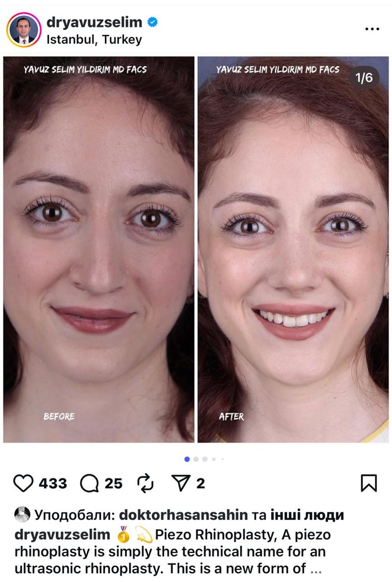 Before and after result by Dr. Yavuz Selim Yıldırım