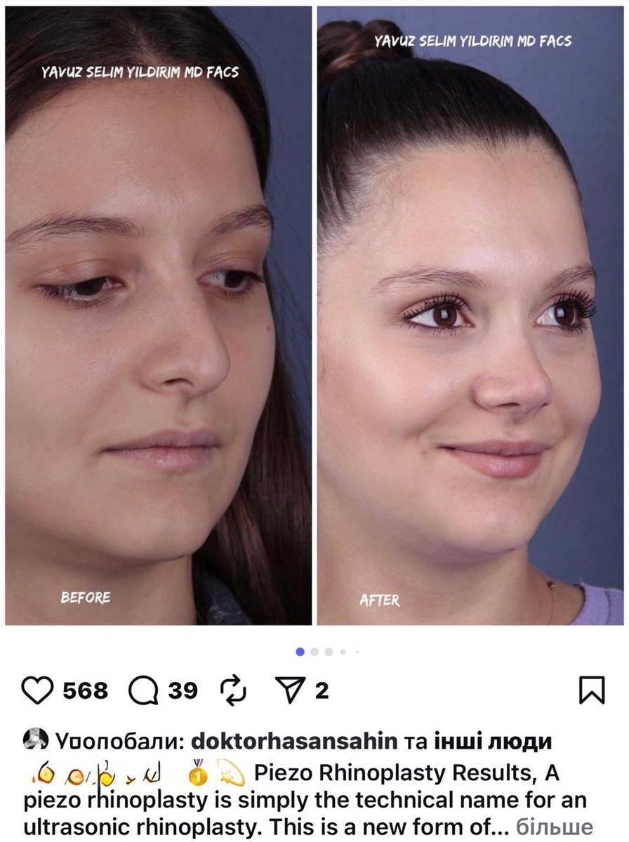 Before and after result by Dr. Yavuz Selim Yıldırım