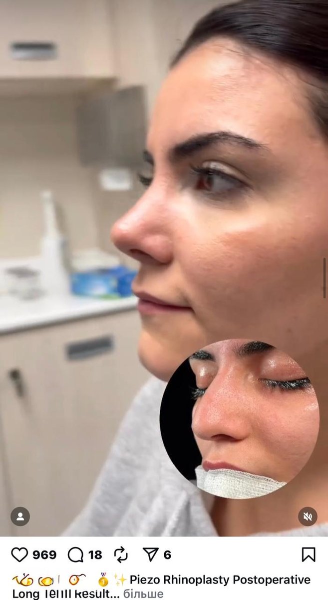 Before and after result by Dr. Yavuz Selim Yıldırım