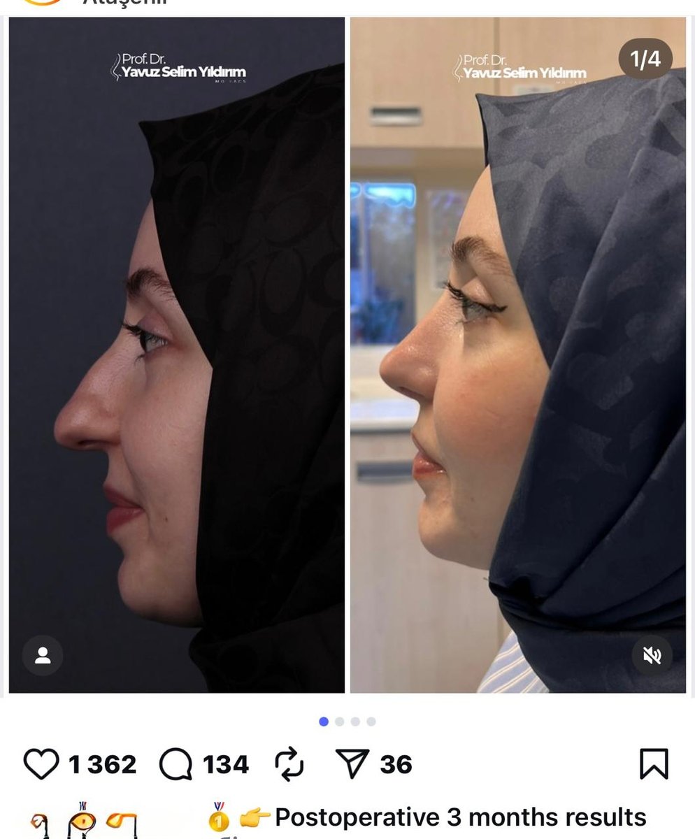 Before and after result by Dr. Yavuz Selim Yıldırım