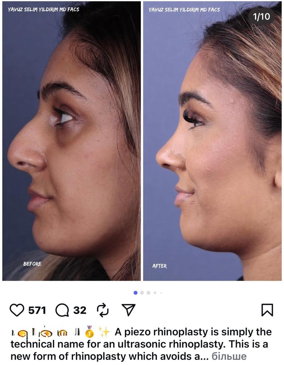 Before and after result by Dr. Yavuz Selim Yıldırım