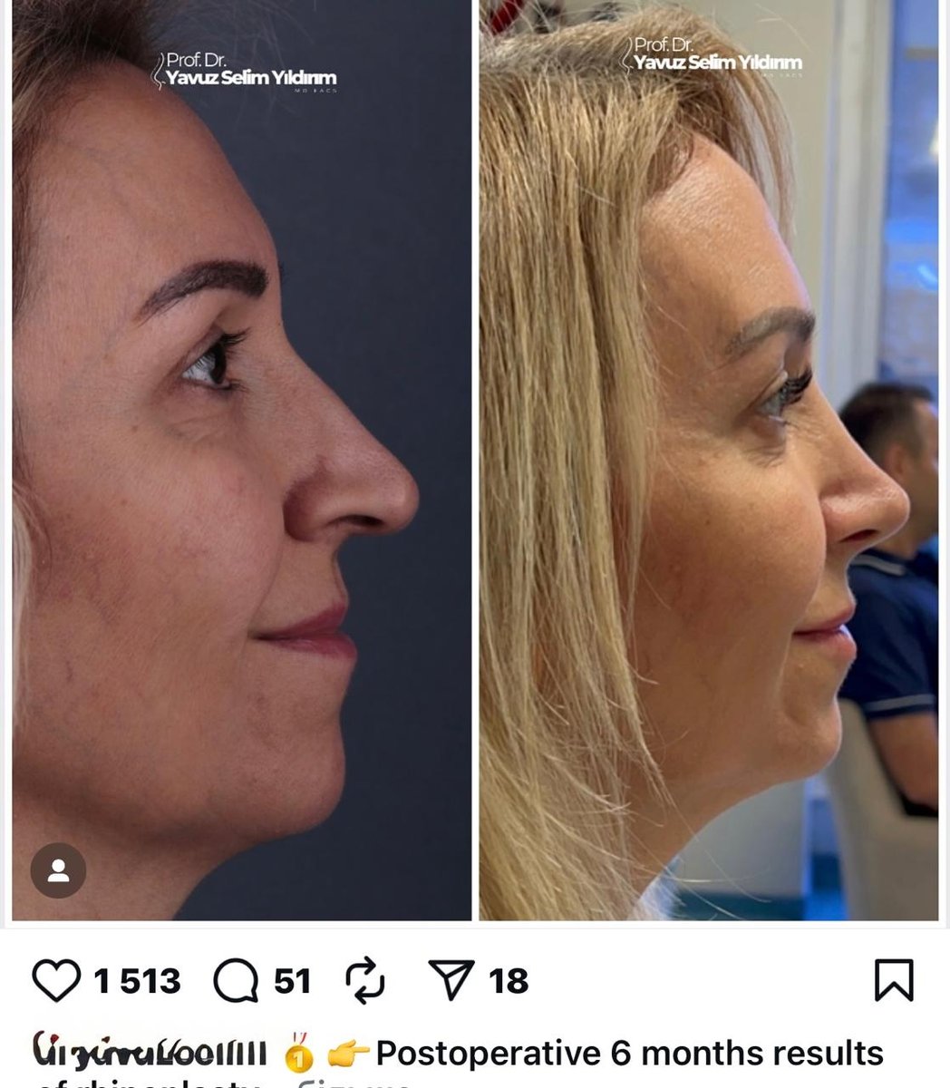 Before and after result by Dr. Yavuz Selim Yıldırım