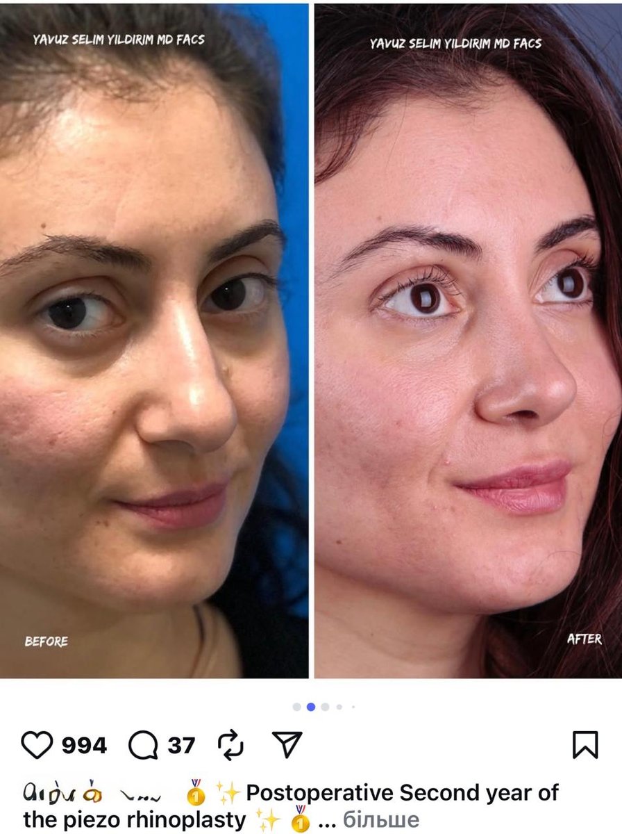 Before and after result by Dr. Yavuz Selim Yıldırım