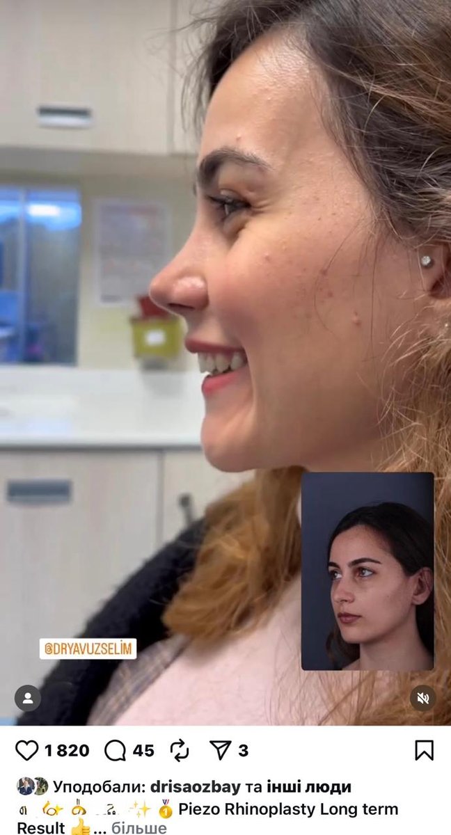 Before and after result by Dr. Yavuz Selim Yıldırım
