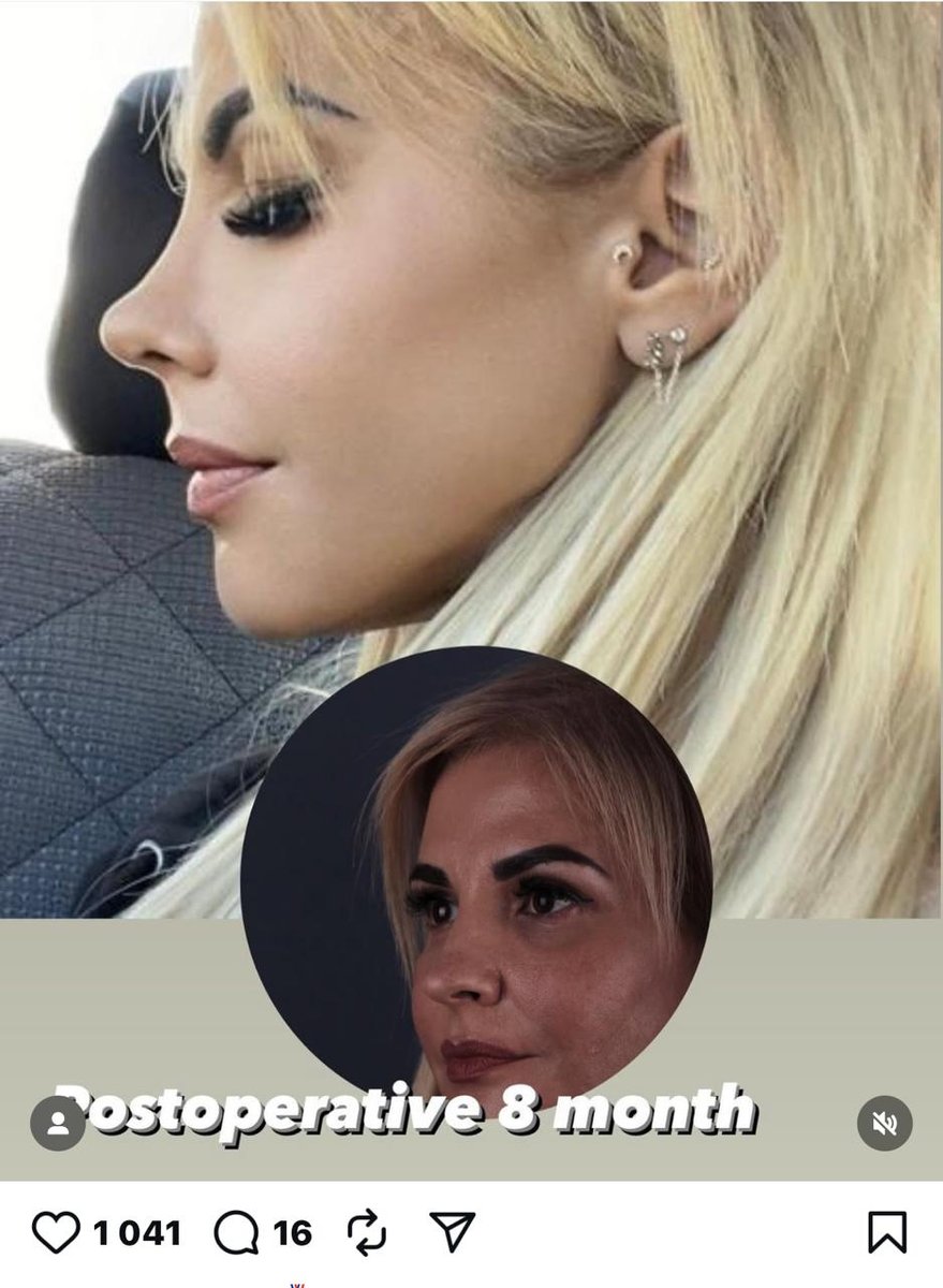 Before and after result by Dr. Yavuz Selim Yıldırım
