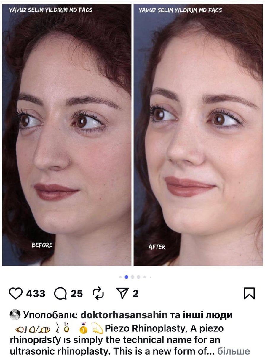 Before and after result by Dr. Yavuz Selim Yıldırım