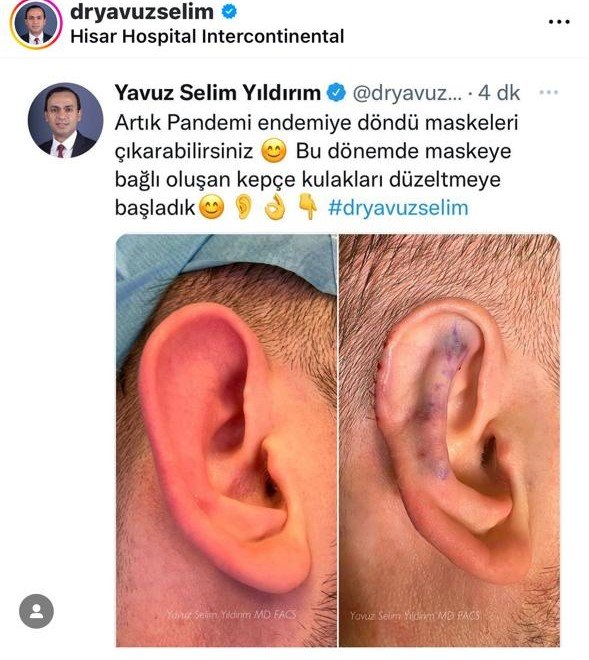 Before and after result by Dr. Yavuz Selim Yıldırım