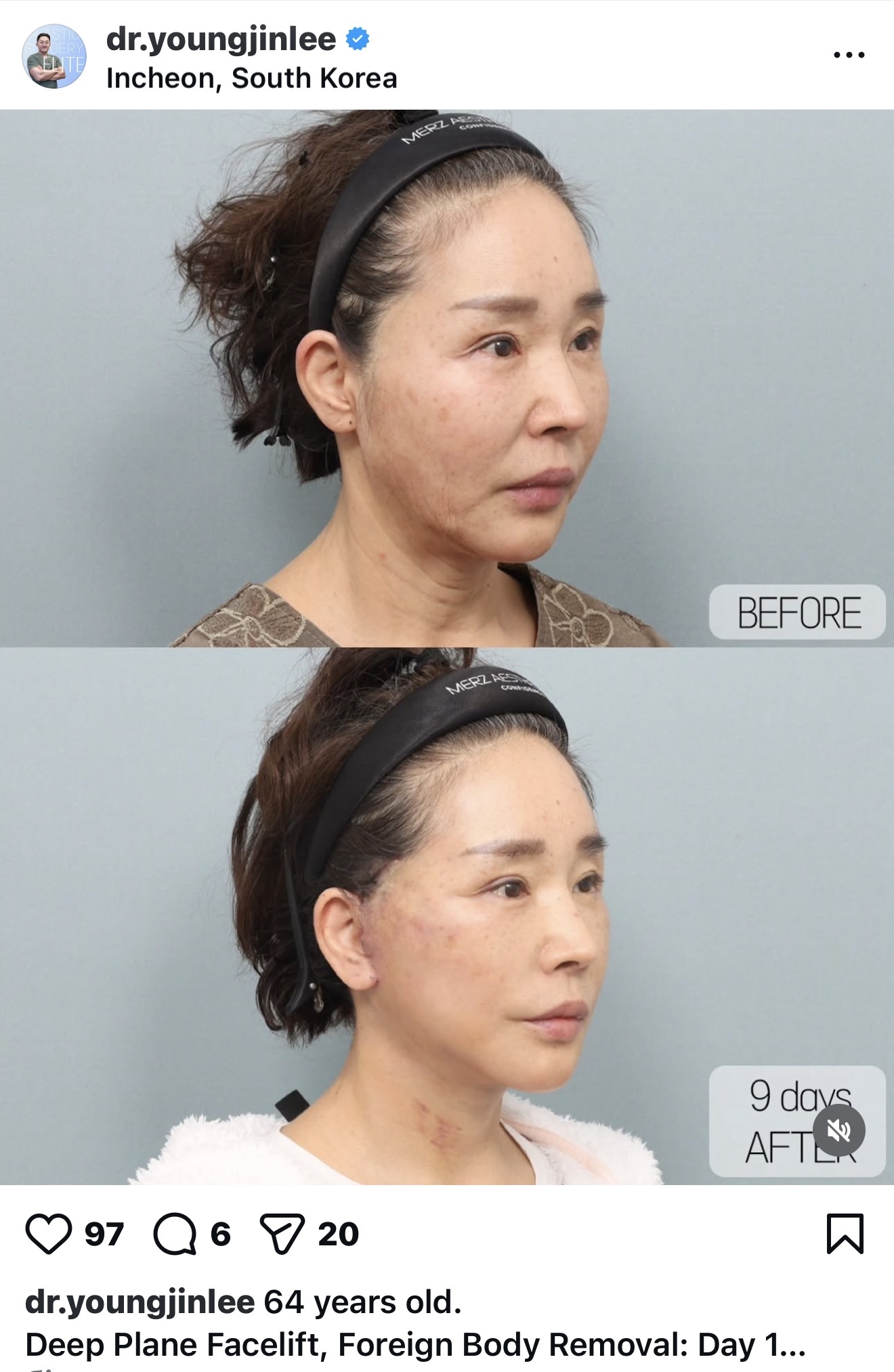 Before and after result by Dr. Young Jin Lee