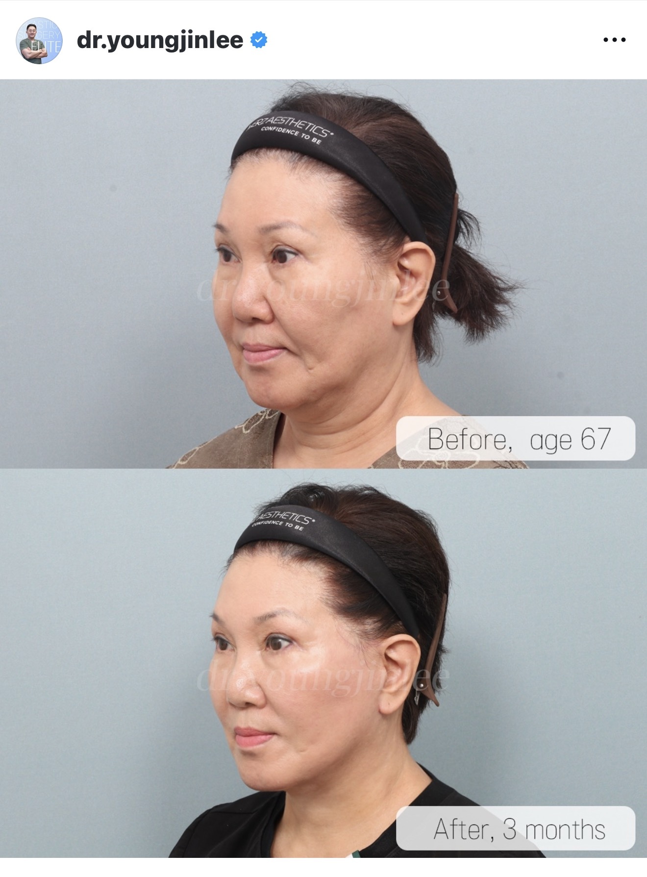 Before and after result by Dr. Young Jin Lee
