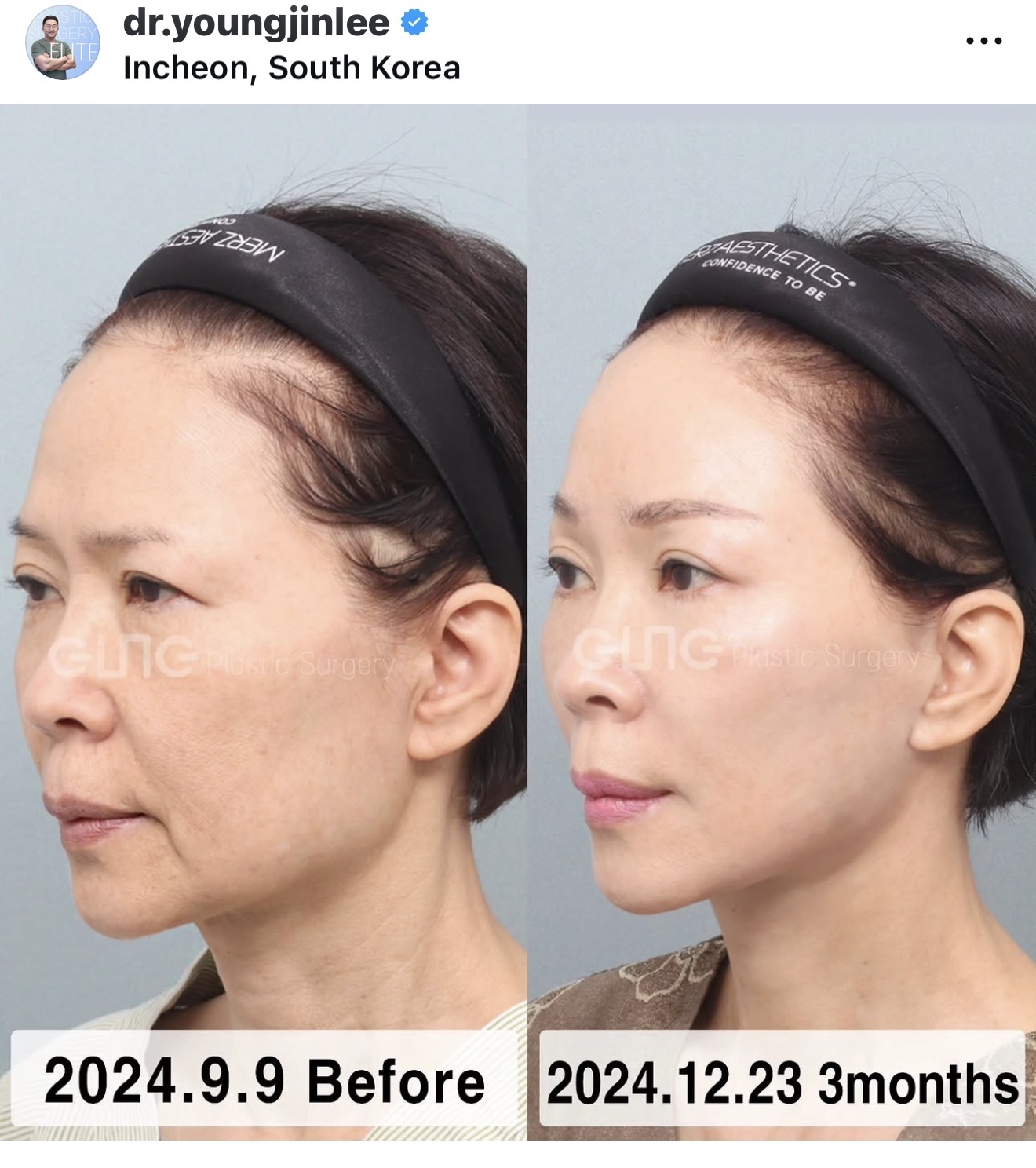 Before and after result by Dr. Young Jin Lee