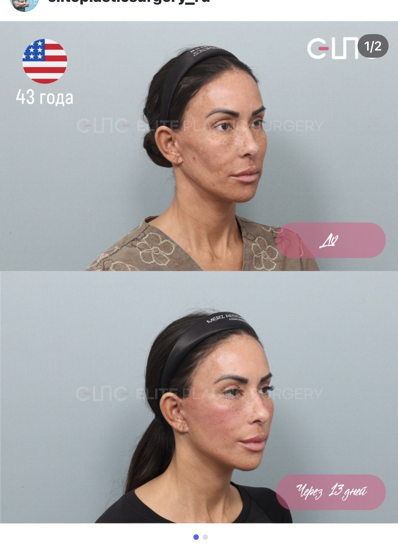 Before and after result by Dr. Young Jin Lee