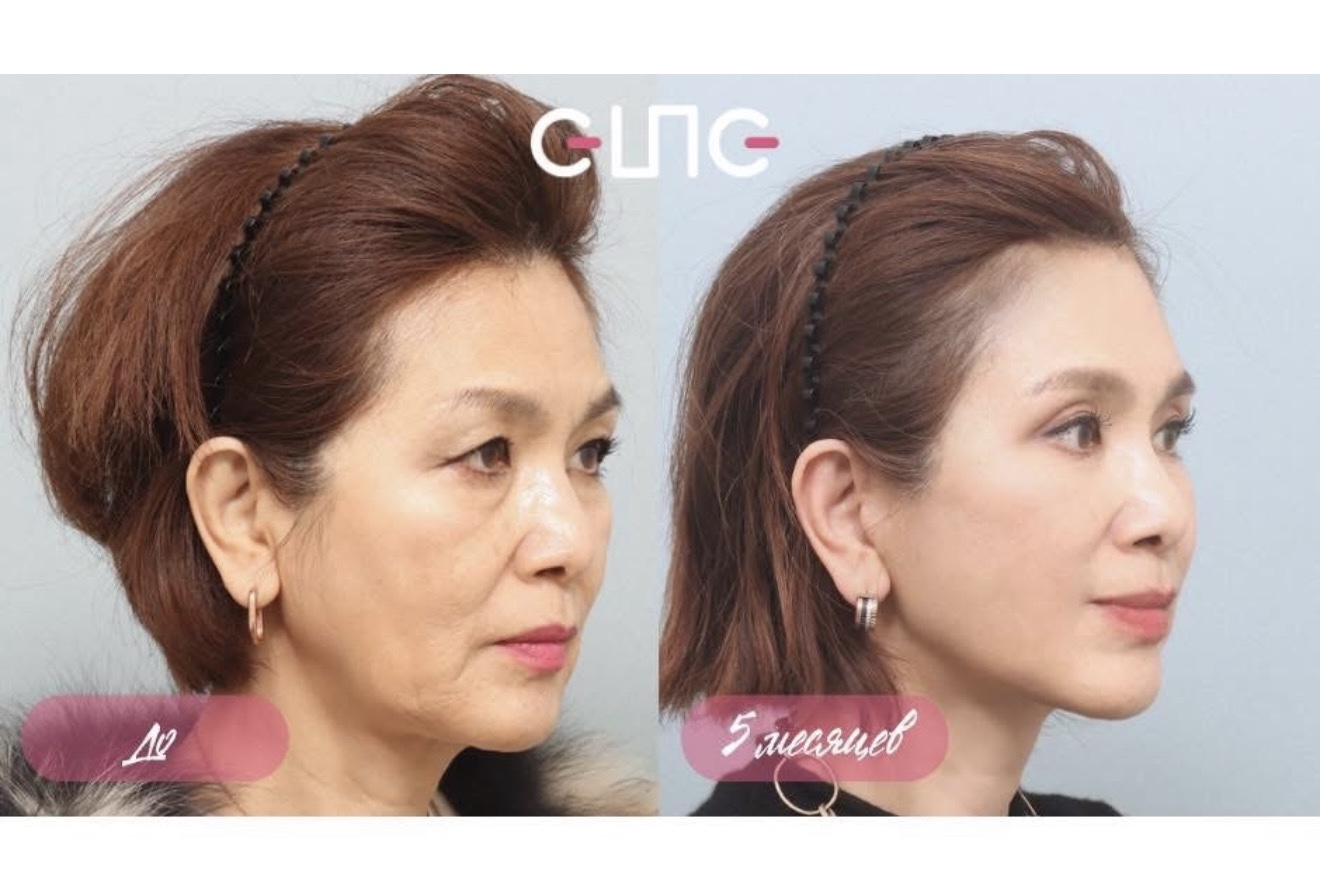 Before and after result by Dr. Young Jin Lee