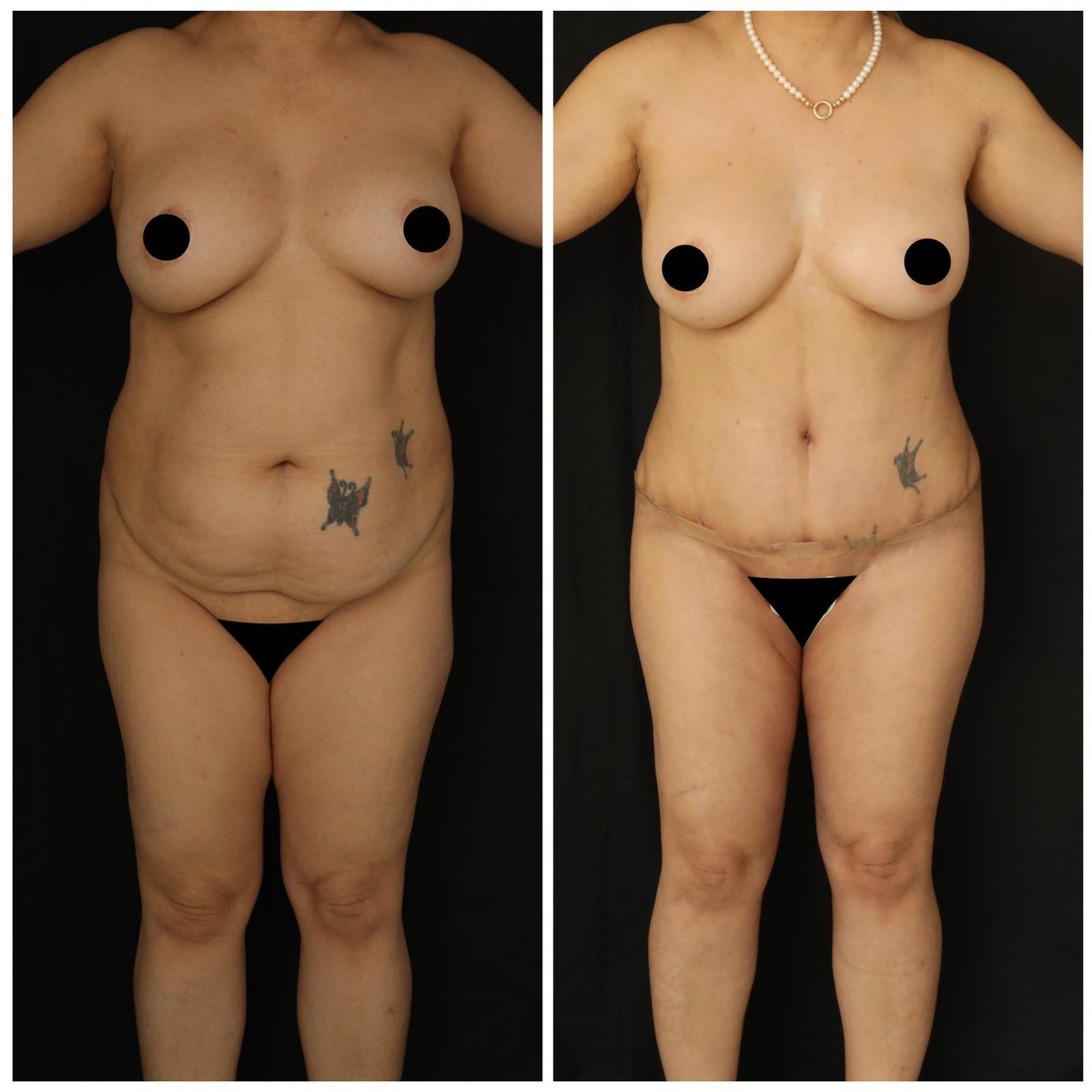 Before and after result by Dr. Yurdakul İlker Manavbasi