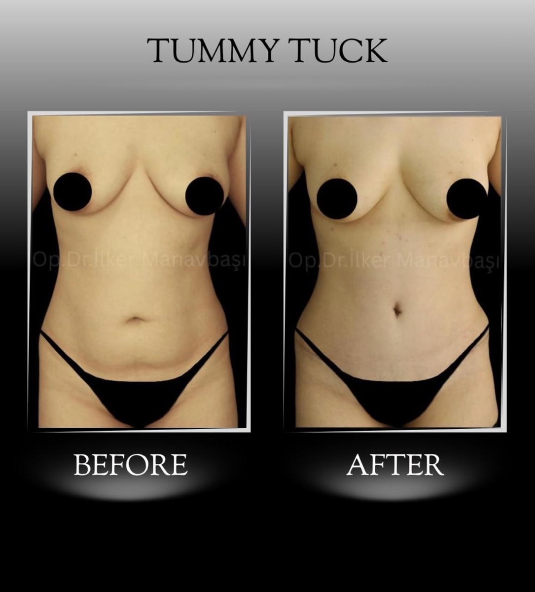Before and after result by Dr. Yurdakul İlker Manavbasi