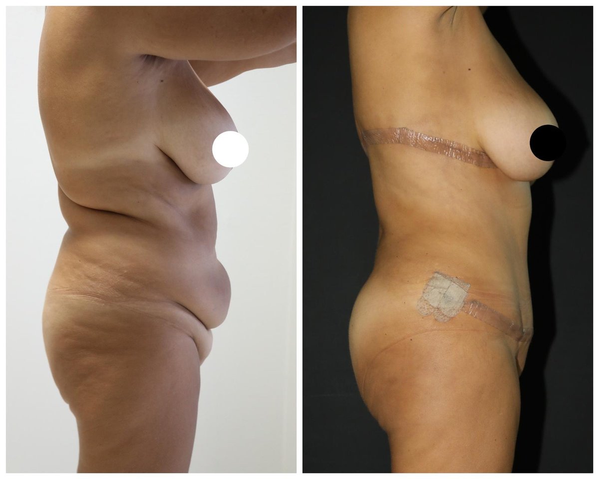 Before and after result by Dr. Yurdakul İlker Manavbasi