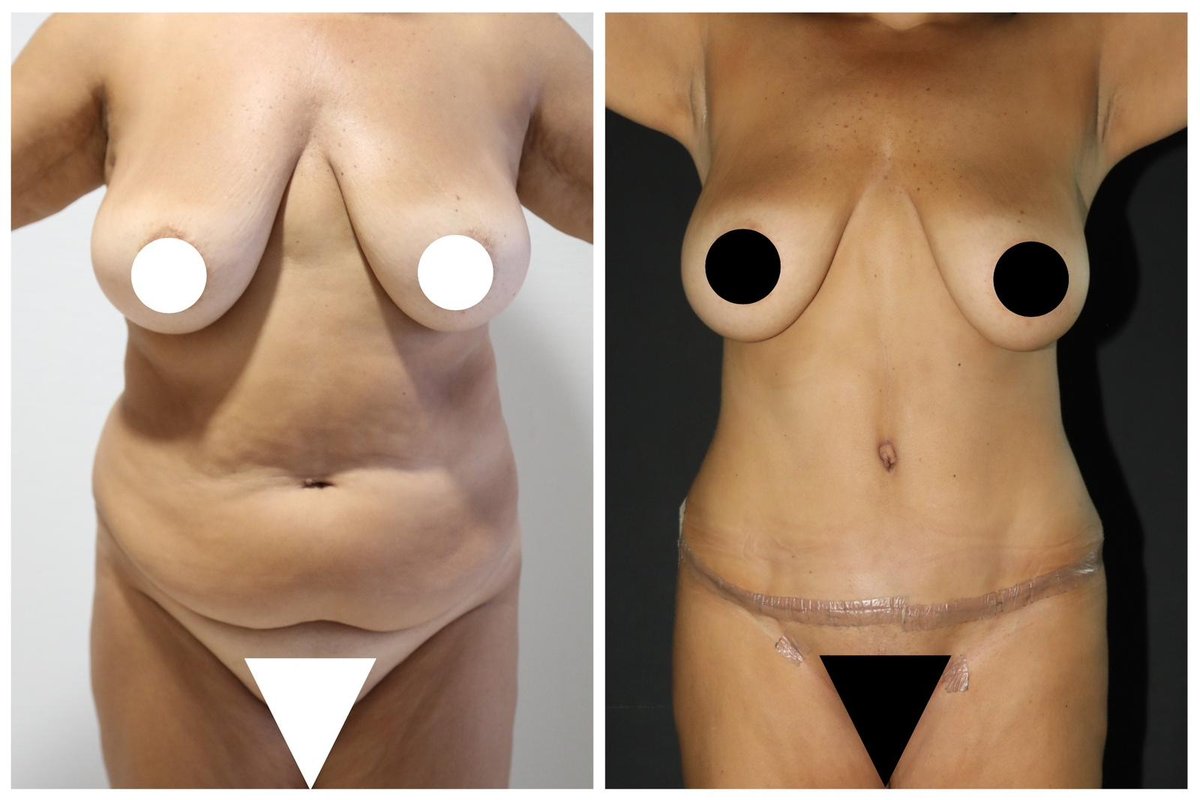 Before and after result by Dr. Yurdakul İlker Manavbasi