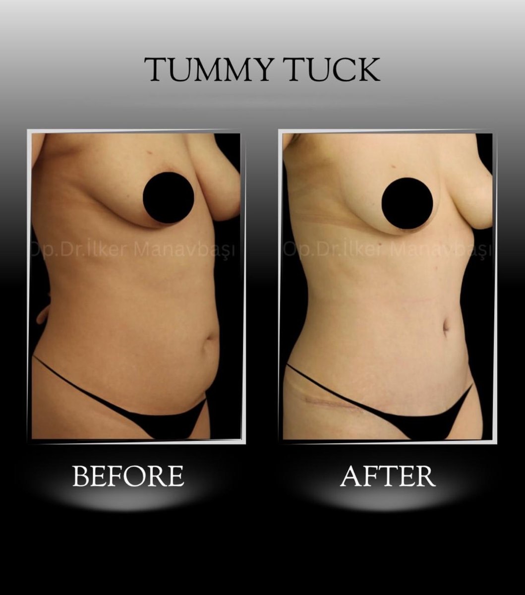 Before and after result by Dr. Yurdakul İlker Manavbasi