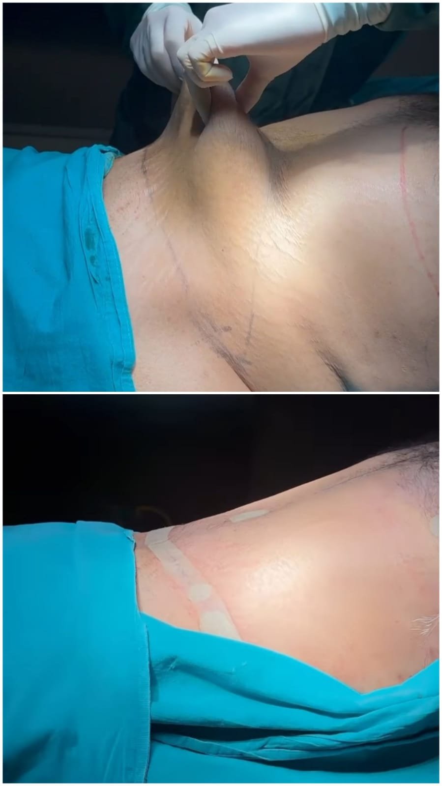Tummy Tuck (Abdominoplasty)