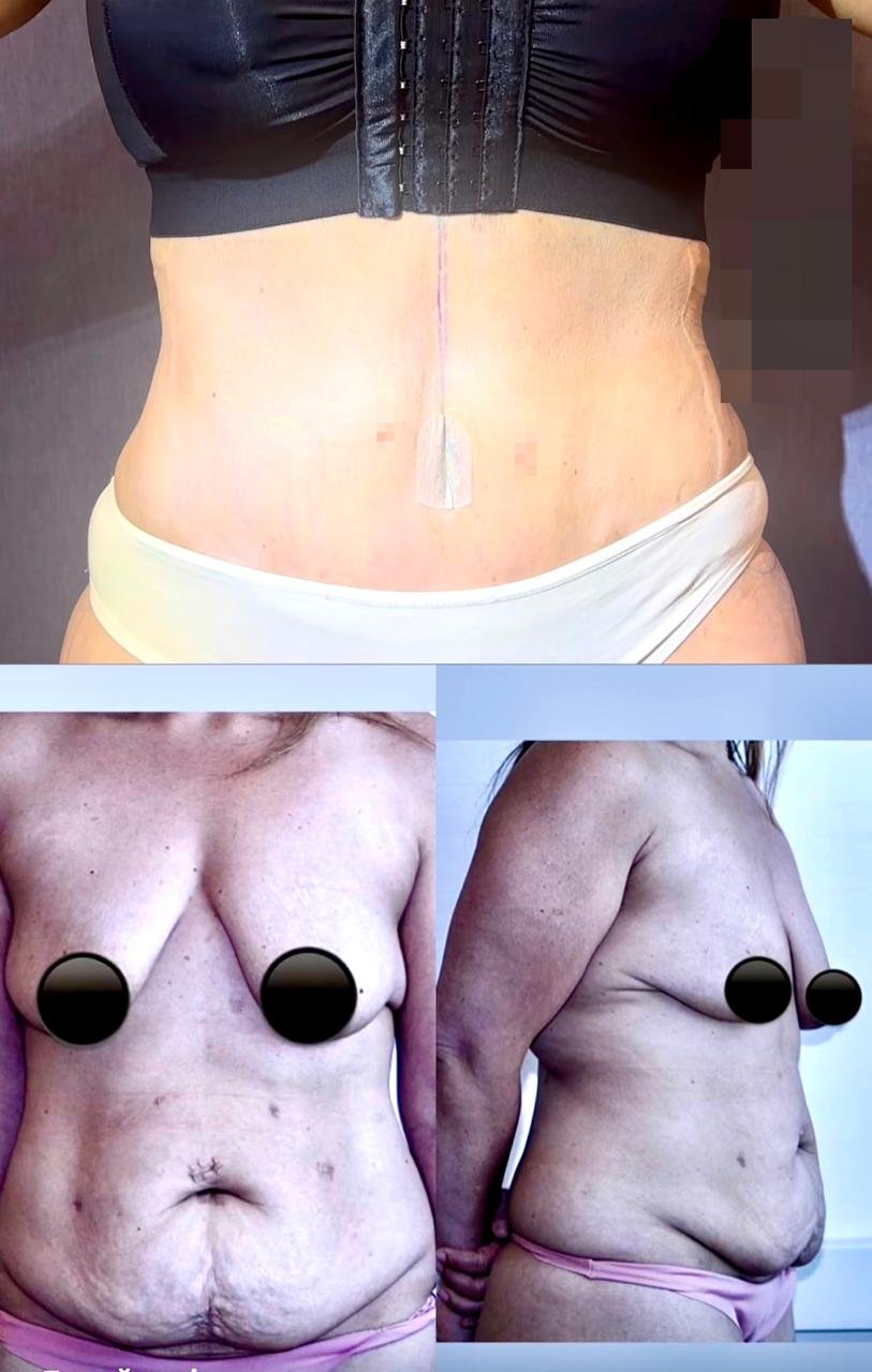 Breast Augmentation
