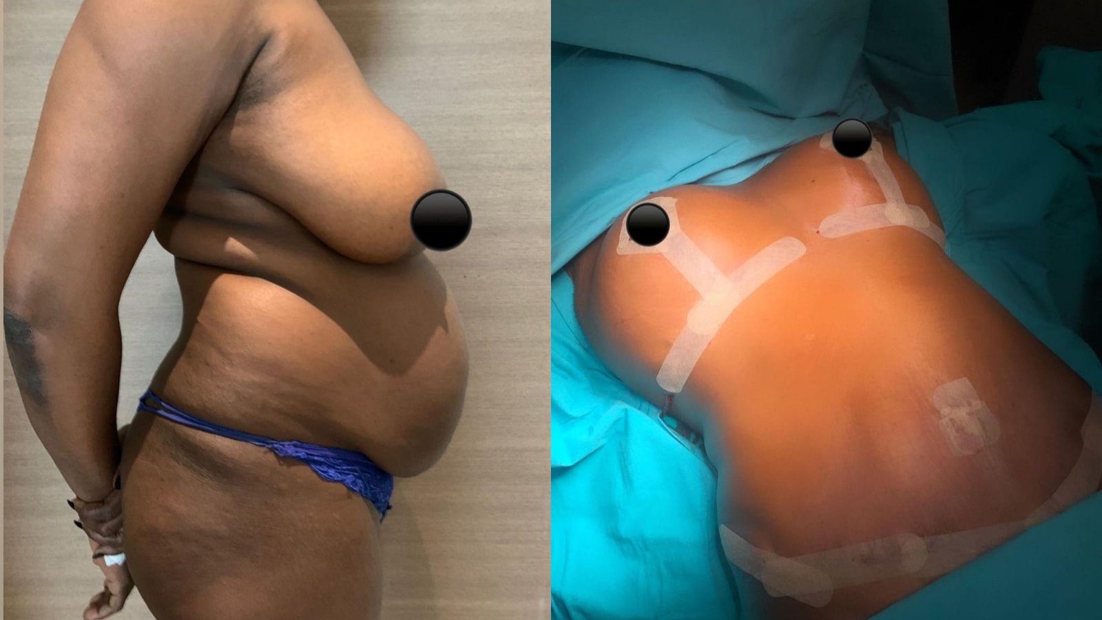 Before and after result by Dr. Ali Can Gunenc