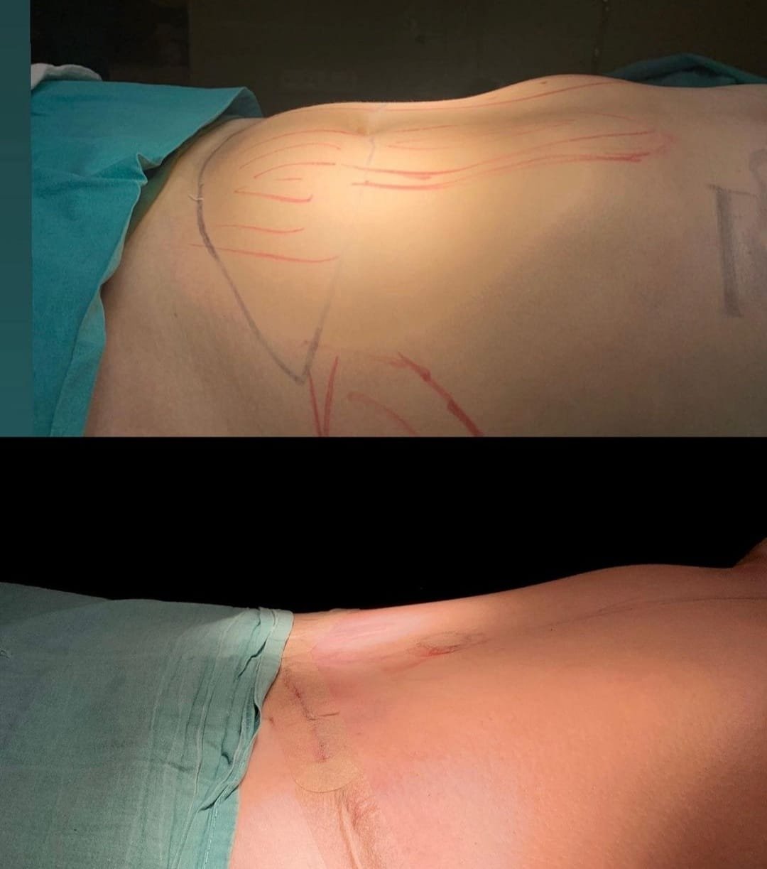 Before and after result by Dr. Ali Can Gunenc