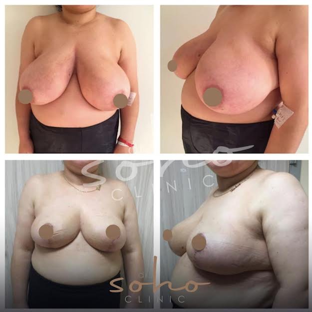 Before and after result by Dr. Ali Can Gunenc