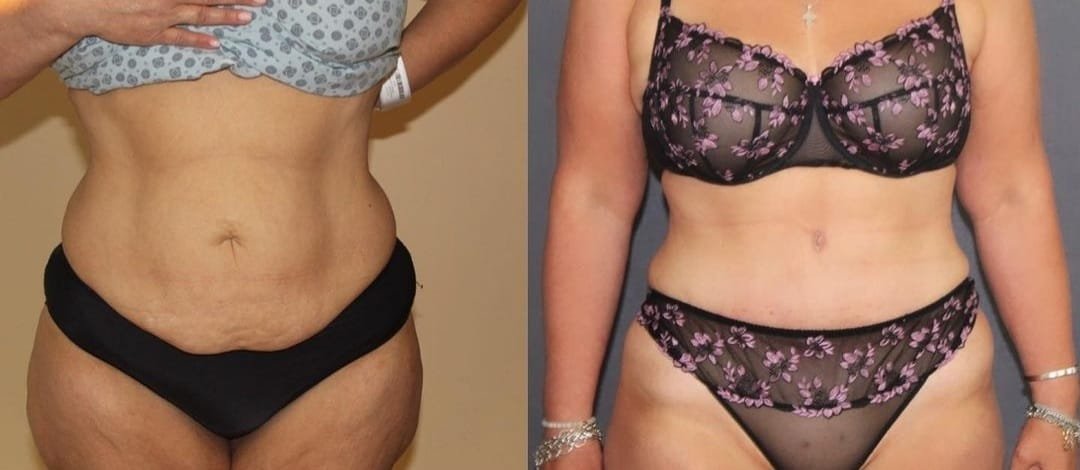 Before and after result by Dr. Ali Can Gunenc