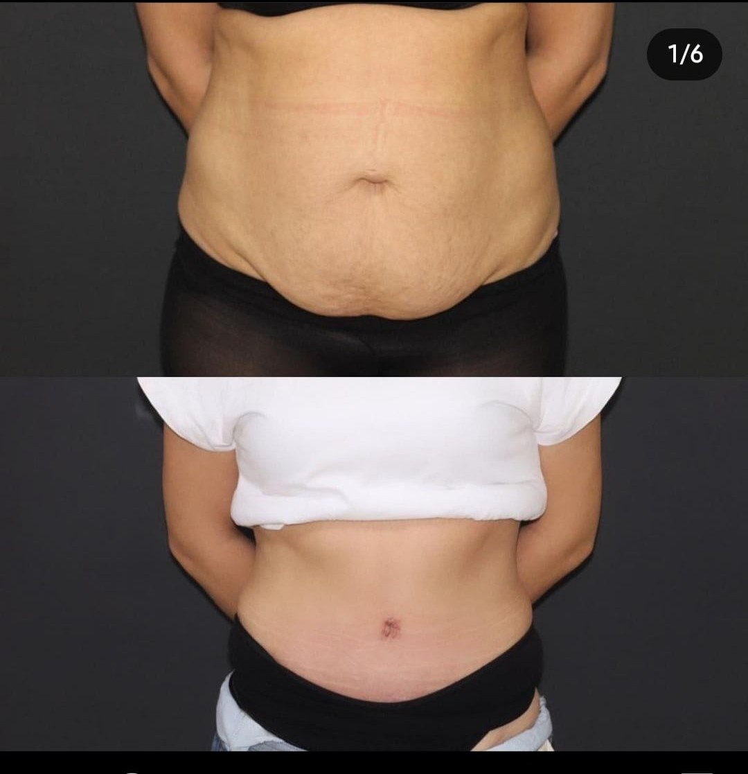 Before and after result by Dr. Ali Can Gunenc