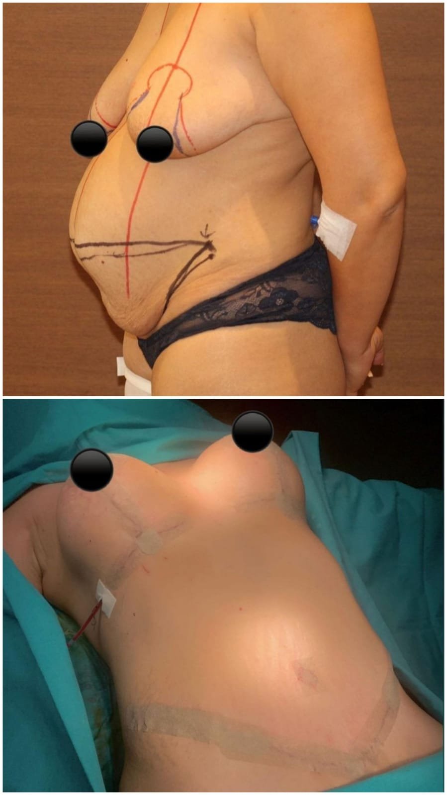 Before and after result by Dr. Ali Can Gunenc