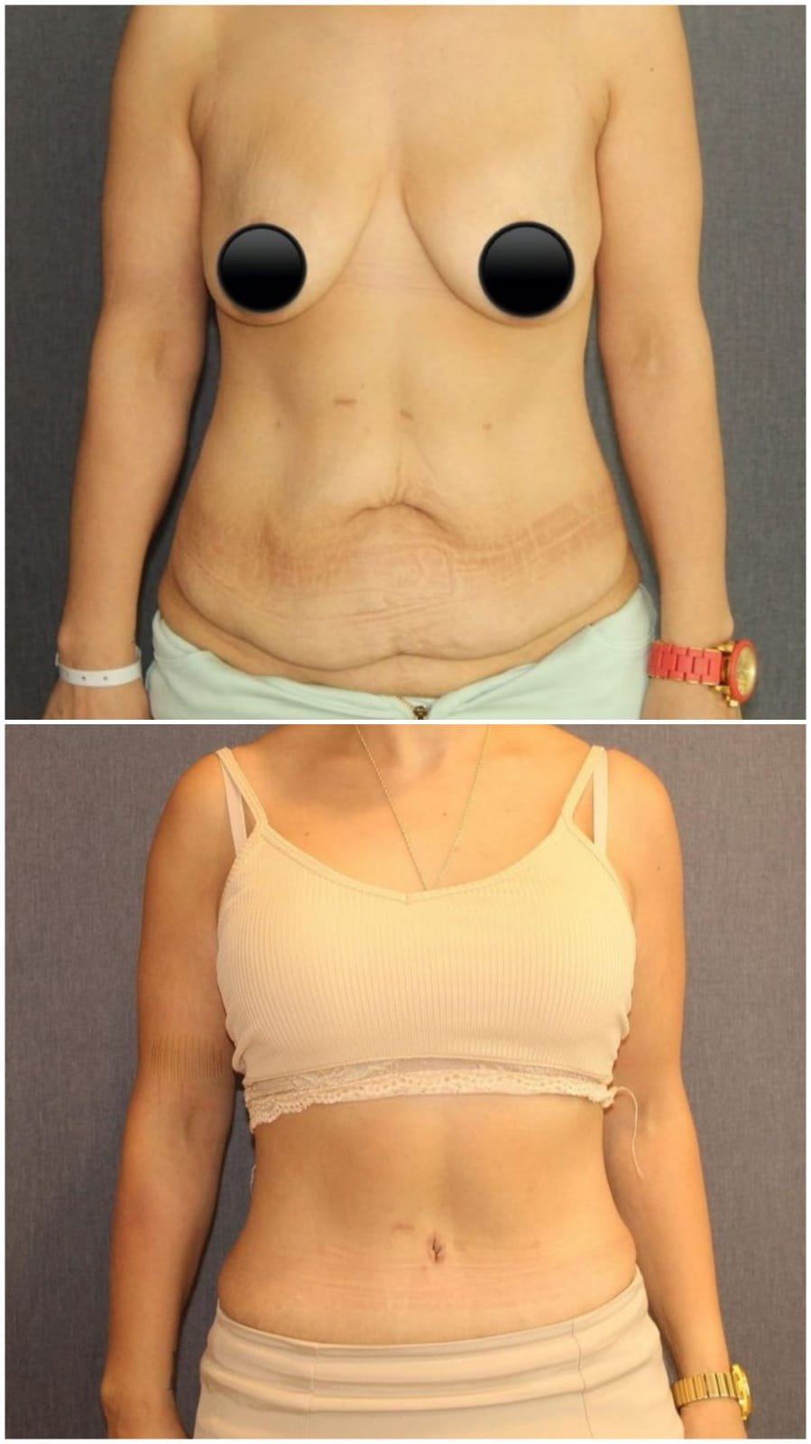 Before and after result by Dr. Ali Can Gunenc