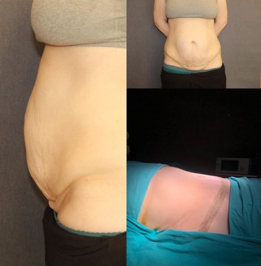 Before and after result by Dr. Ali Can Gunenc