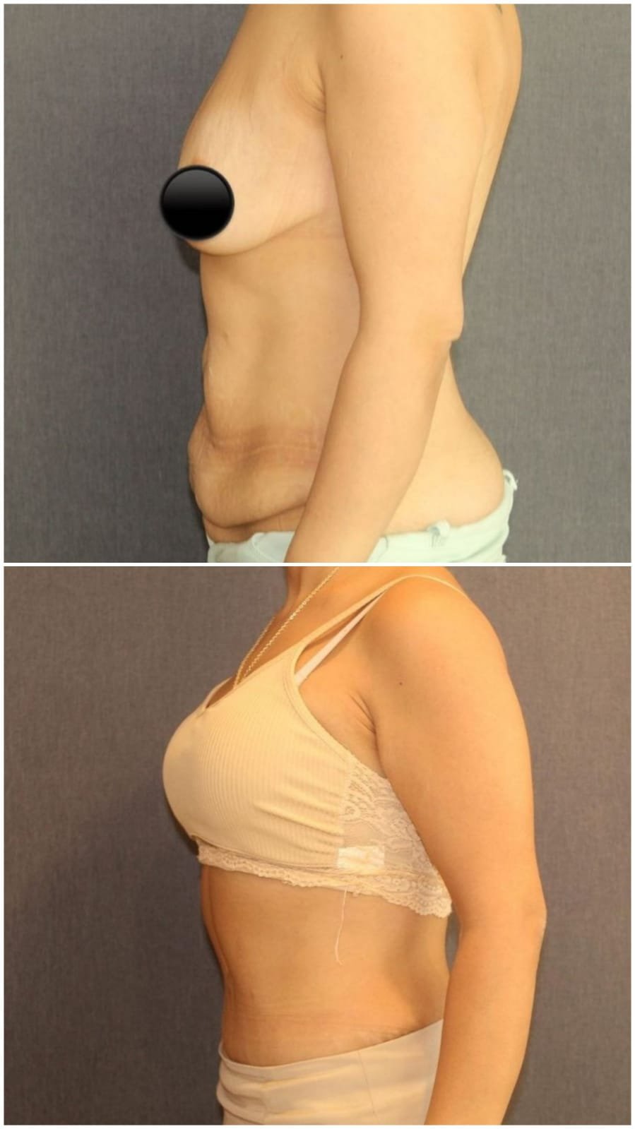 Before and after result by Dr. Ali Can Gunenc
