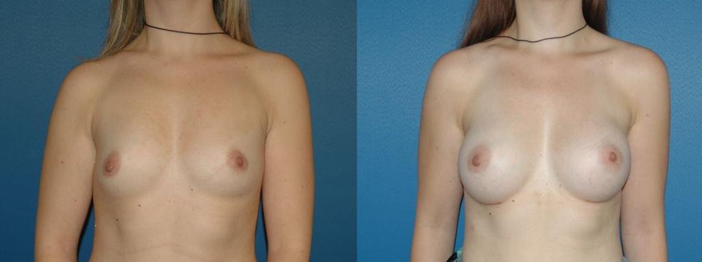Buttock Augmentation (BBL)
