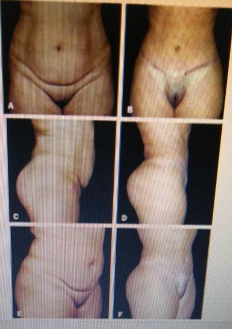 Before and after result by Dr. Çağrı Sade