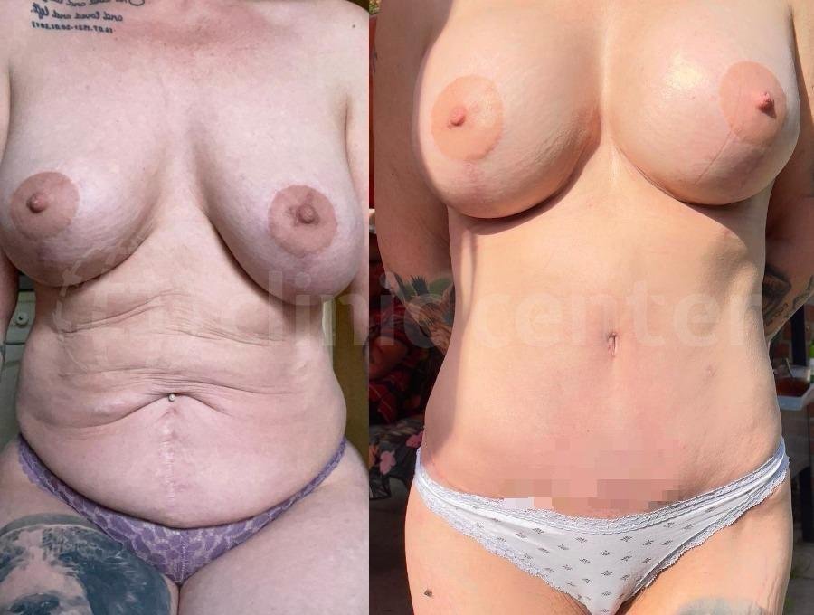 Before and after result by Dr. Çağrı Sade