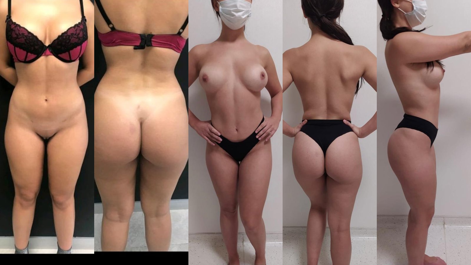 Before and after result by Dr. Çağrı Sade