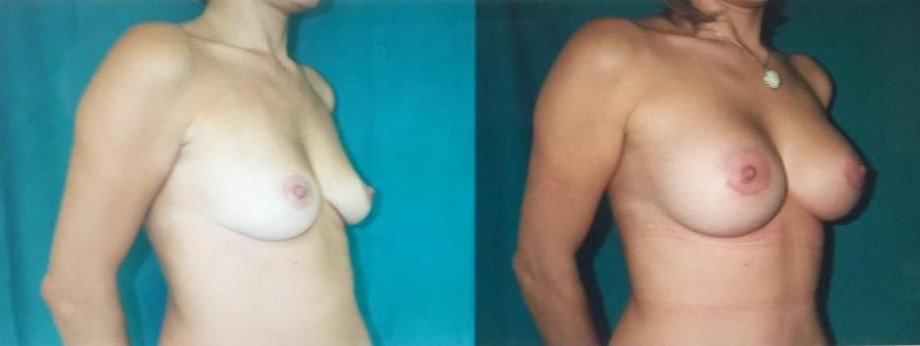 Before and after result by Dr. Çağrı Sade