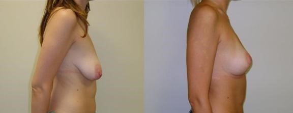 Before and after result by Dr. Çağrı Sade