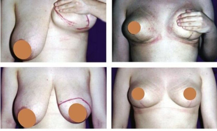 Before and after result by Dr. Çağrı Sade