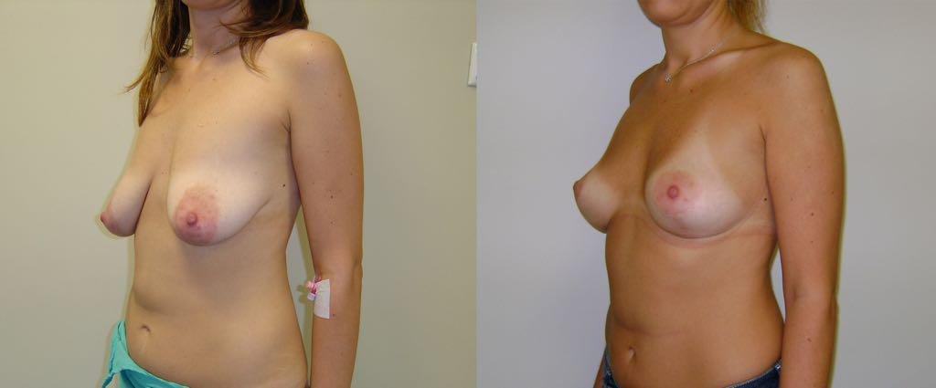 Before and after result by Dr. Çağrı Sade